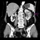 Subsegmental kidney infraction or focal nephritis: CT - Computed tomography